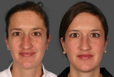 Rhinoplasty Before & After Gallery - Patient 357531 - Image 1