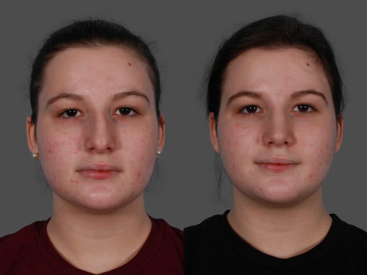 Rhinoplasty Before & After Gallery - Patient 114333 - Image 1