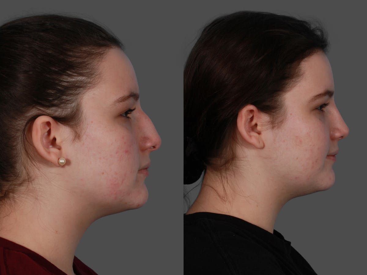 Rhinoplasty Before & After Gallery - Patient 114333 - Image 3