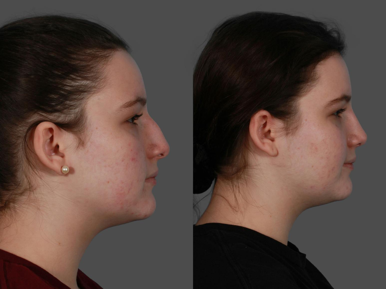 Rhinoplasty Before & After Gallery - Patient 114333 - Image 3