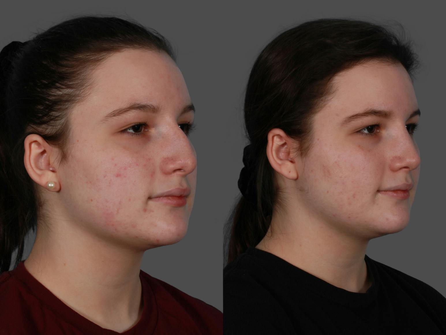 Rhinoplasty Before & After Gallery - Patient 114333 - Image 2
