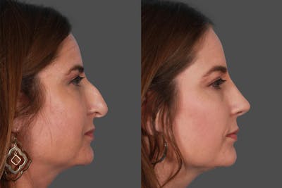 Rhinoplasty Before & After Gallery - Patient 385470 - Image 1