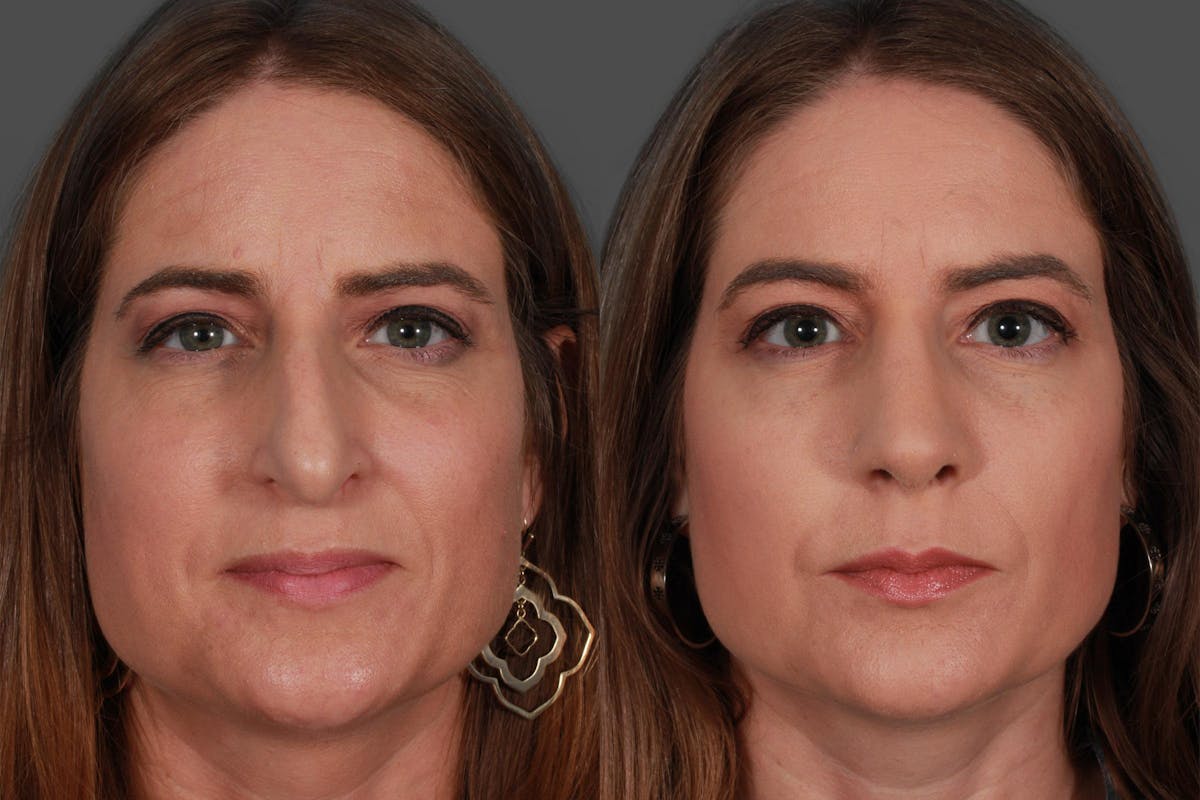Rhinoplasty Before & After Gallery - Patient 385470 - Image 2