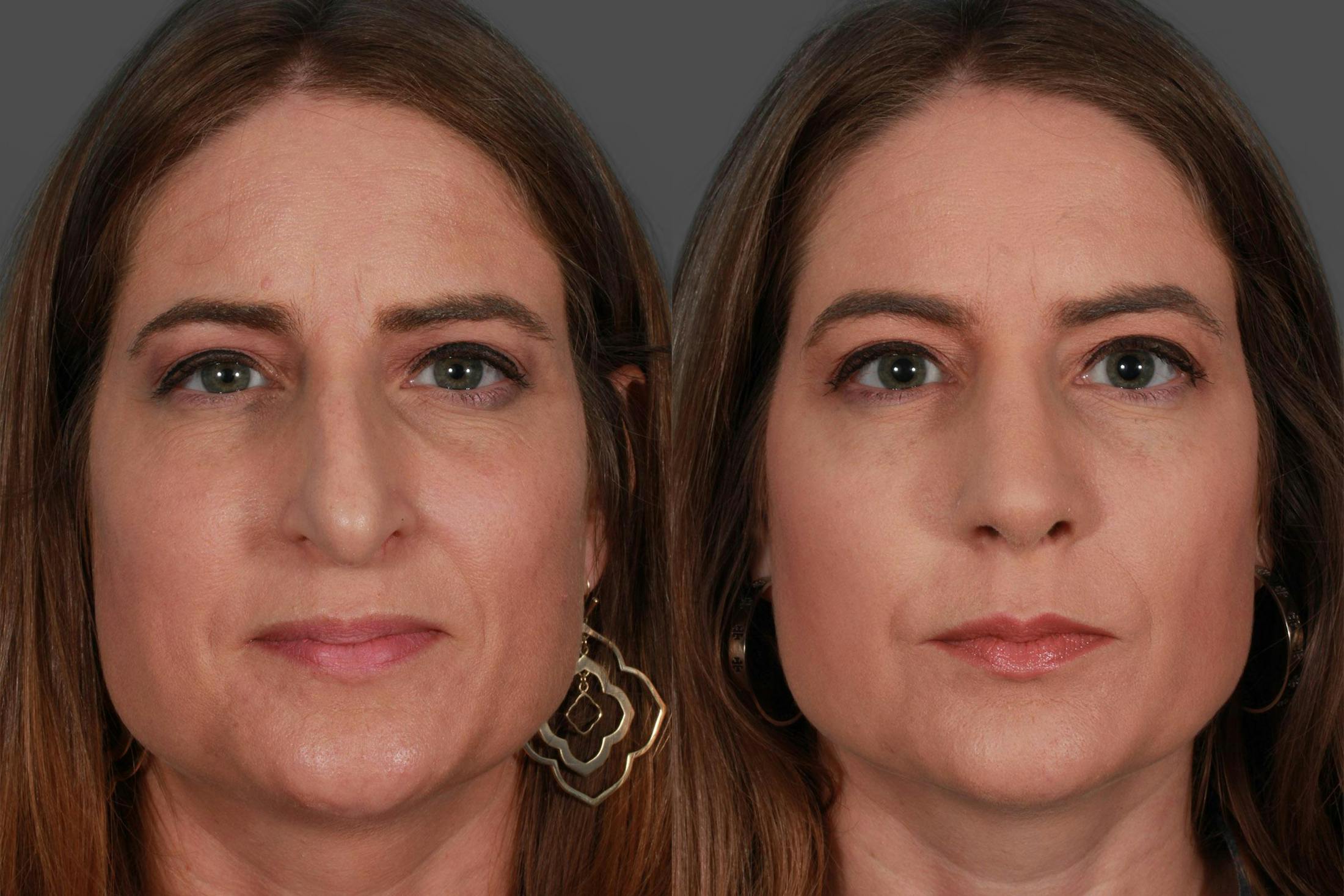 Rhinoplasty Before & After Gallery - Patient 385470 - Image 2