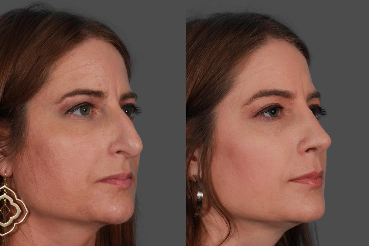 Rhinoplasty Before & After Gallery - Patient 385470 - Image 3