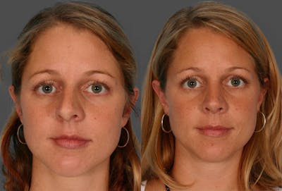 Rhinoplasty Before & After Gallery - Patient 413271 - Image 1