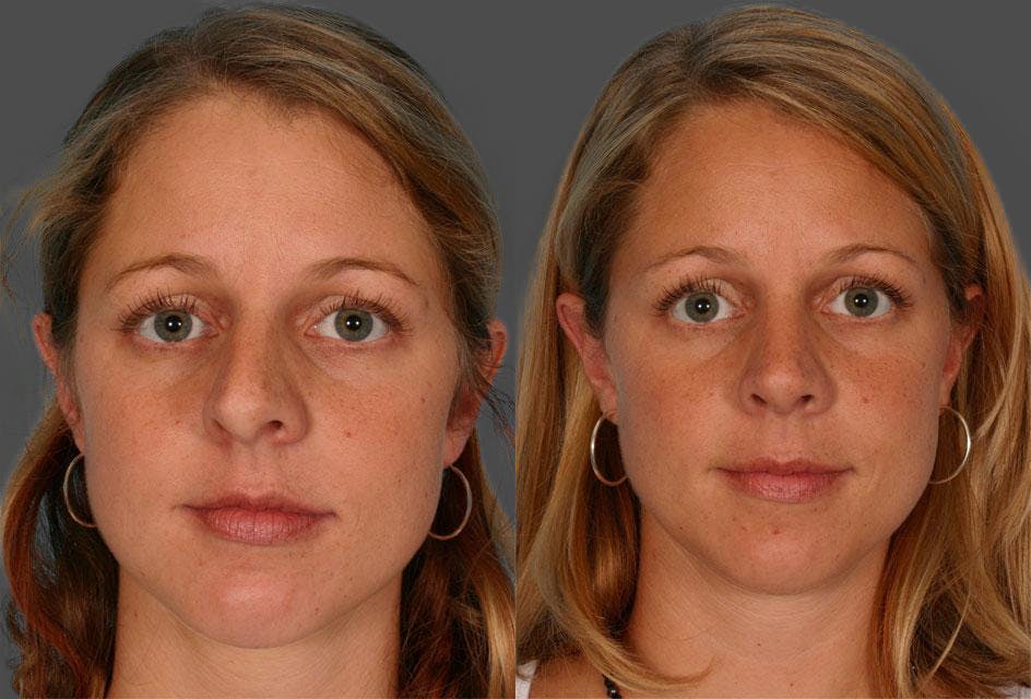 Rhinoplasty Before & After Gallery - Patient 413271 - Image 1