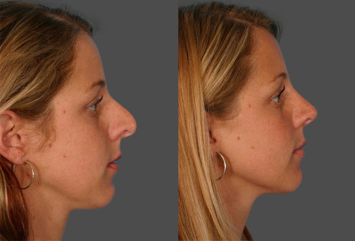 Rhinoplasty Before & After Gallery - Patient 413271 - Image 2
