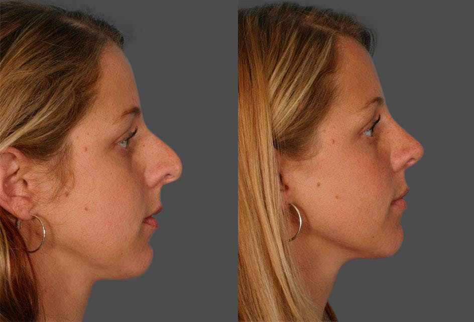 Rhinoplasty Before & After Gallery - Patient 413271 - Image 2