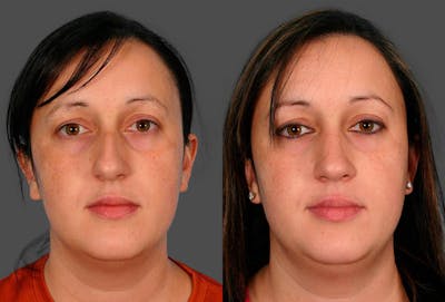Rhinoplasty Before & After Gallery - Patient 415648 - Image 1