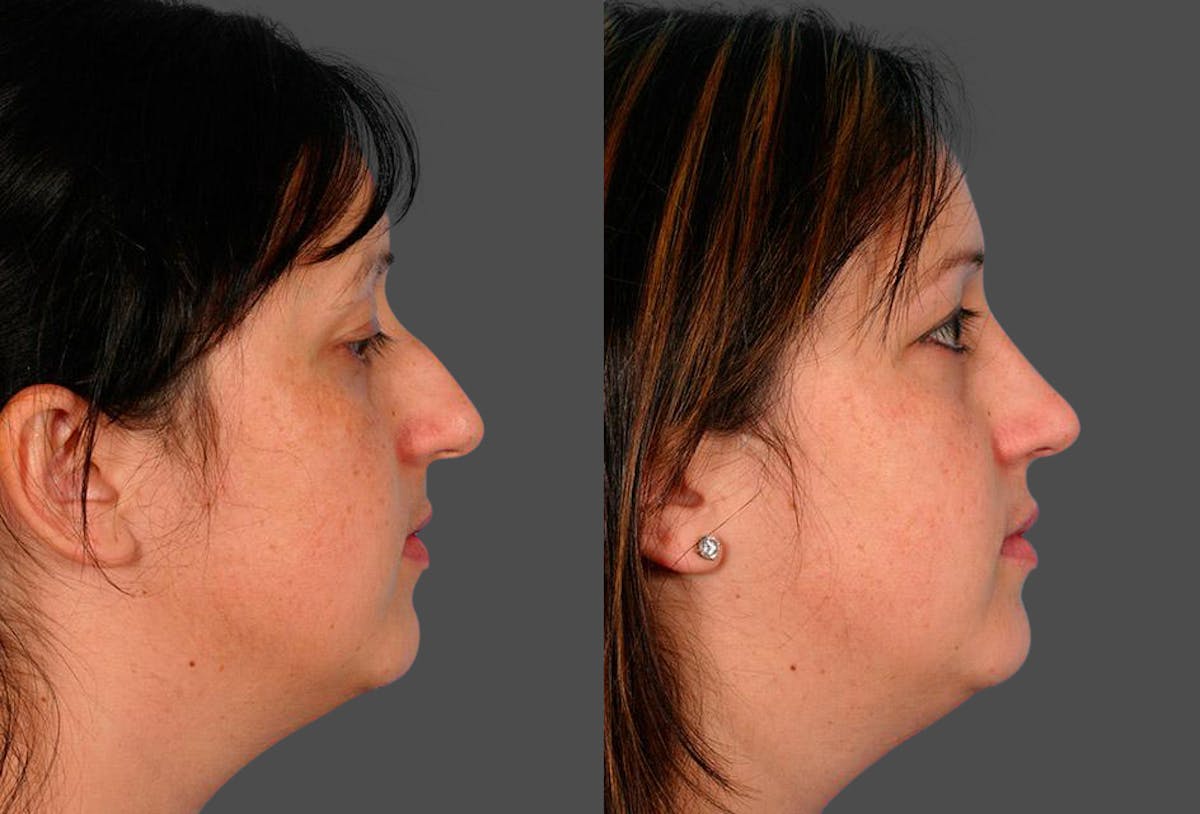 Rhinoplasty Before & After Gallery - Patient 415648 - Image 2