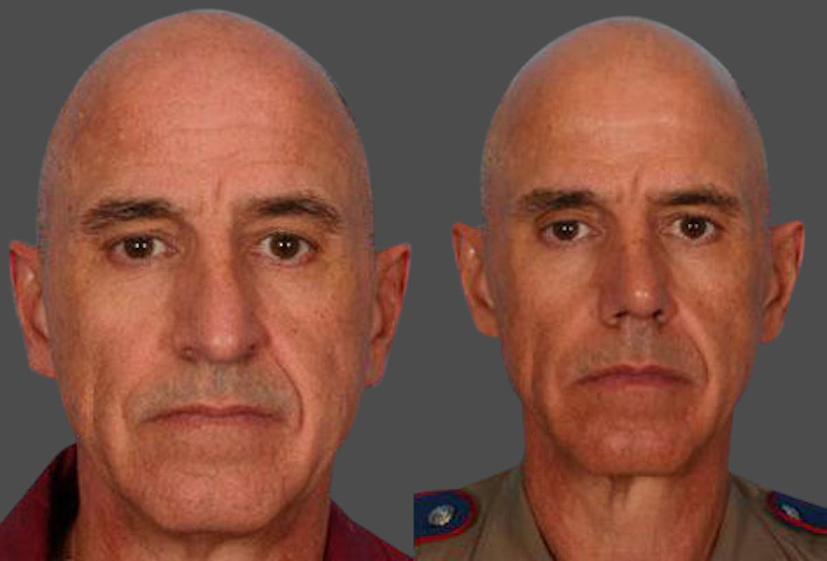 Rhinoplasty Before & After Gallery - Patient 421070 - Image 1