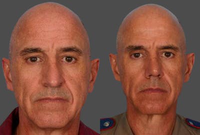 Rhinoplasty Before & After Gallery - Patient 421070 - Image 1