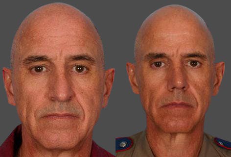 Rhinoplasty Before & After Gallery - Patient 421070 - Image 1