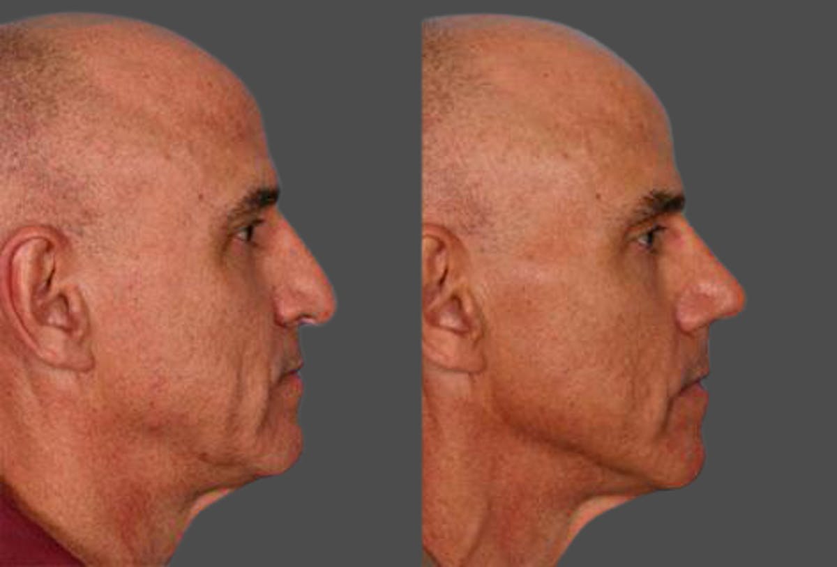 Rhinoplasty Before & After Gallery - Patient 421070 - Image 2
