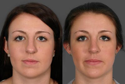Rhinoplasty Before & After Gallery - Patient 558721 - Image 1