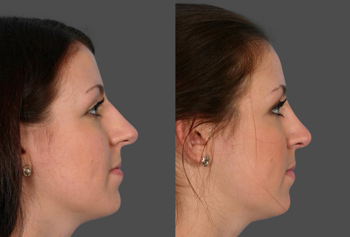 Rhinoplasty Before & After Gallery - Patient 558721 - Image 2