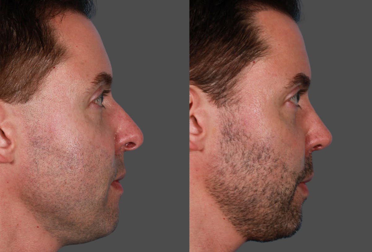 Rhinoplasty Before & After Gallery - Patient 822334 - Image 2