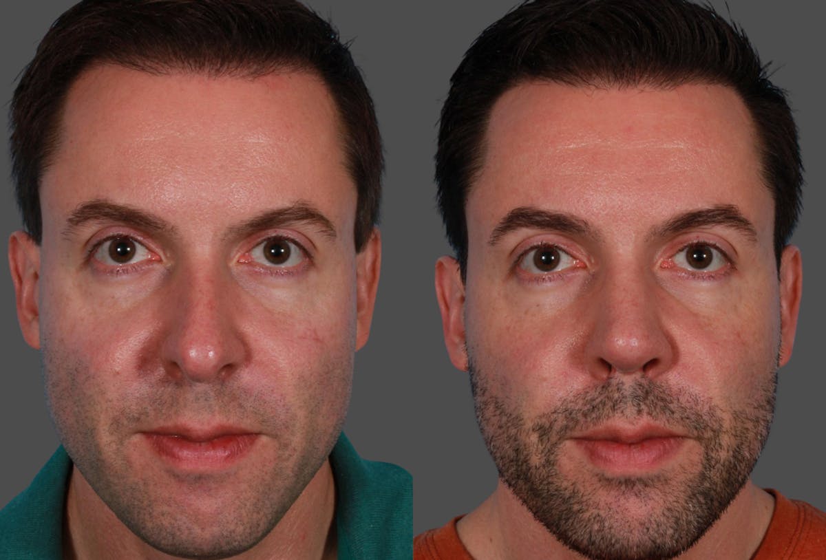 Rhinoplasty Before & After Gallery - Patient 822334 - Image 1