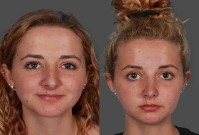 Revision Rhinoplasty Before & After Gallery - Patient 197318 - Image 1