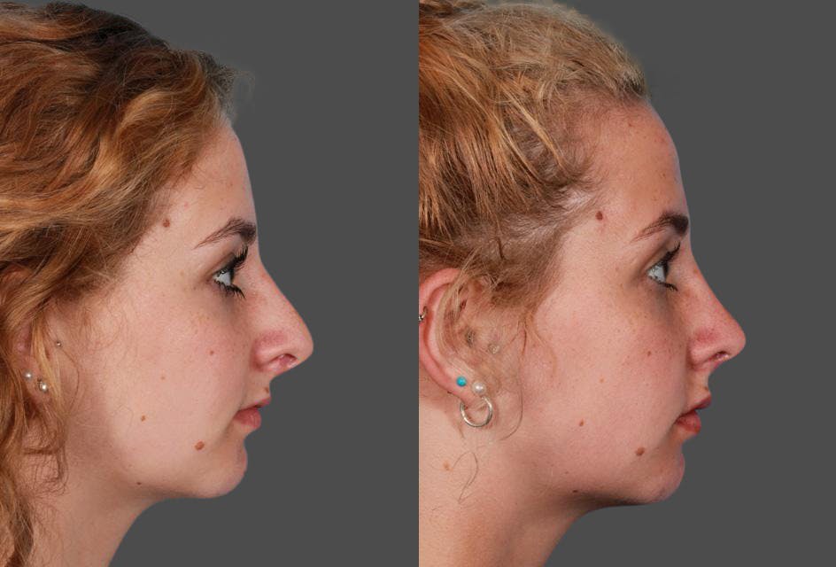 Revision Rhinoplasty Before & After Gallery - Patient 197318 - Image 2