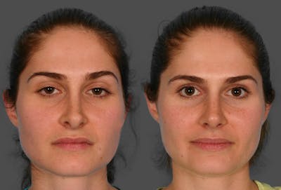 Revision Rhinoplasty Before & After Gallery - Patient 213999 - Image 1