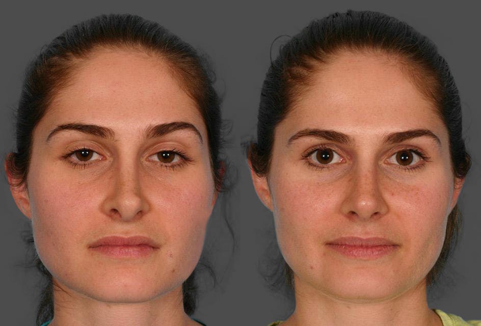 Revision Rhinoplasty Before & After Gallery - Patient 213999 - Image 1