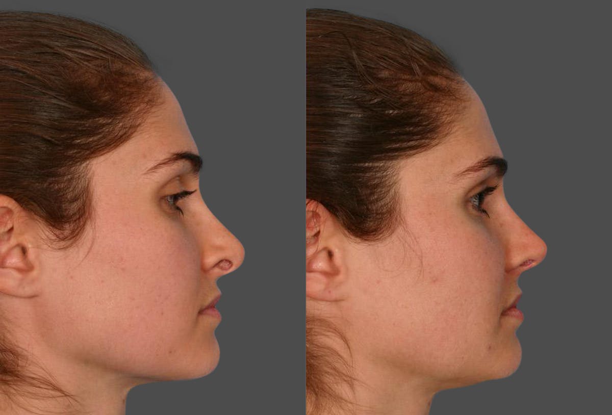 Revision Rhinoplasty Before & After Gallery - Patient 213999 - Image 2