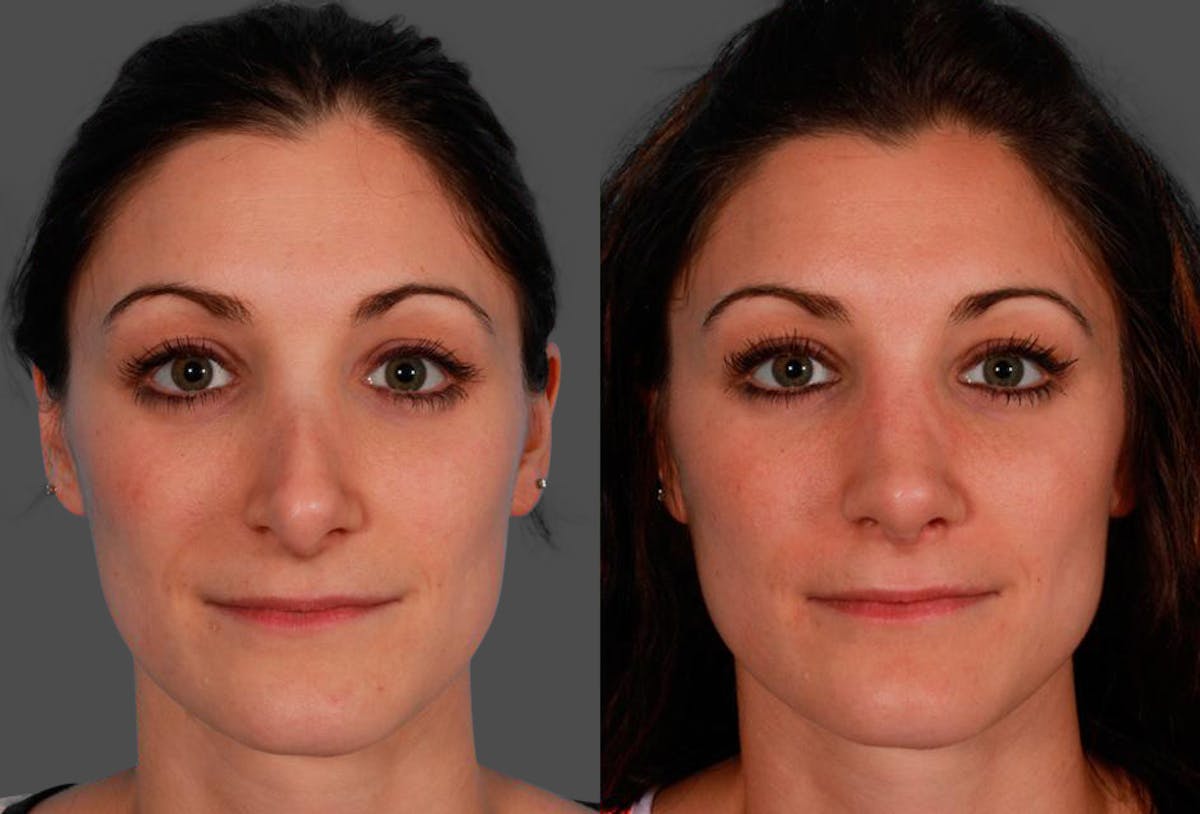 Revision Rhinoplasty Before & After Gallery - Patient 338022 - Image 1