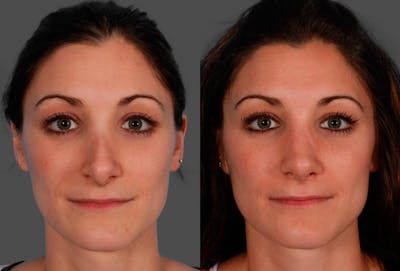 Revision Rhinoplasty Before & After Gallery - Patient 338022 - Image 1