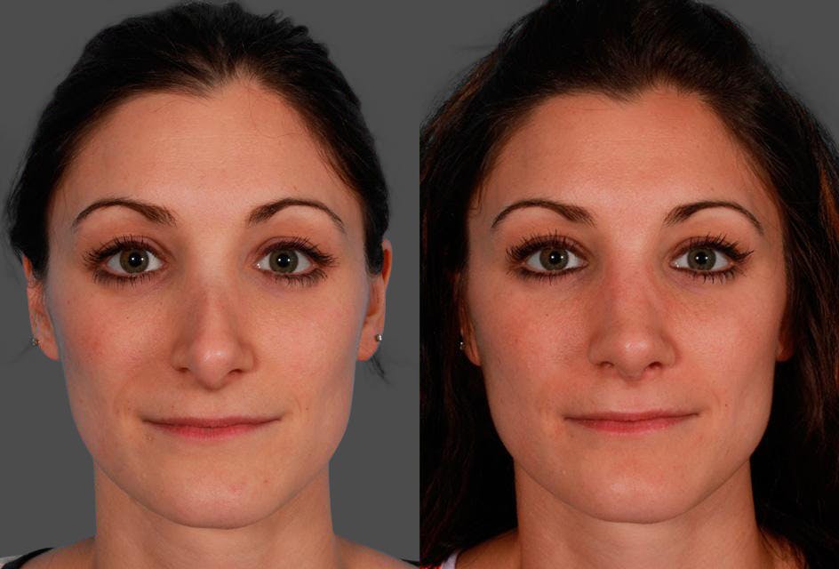 Revision Rhinoplasty Before & After Gallery - Patient 338022 - Image 1