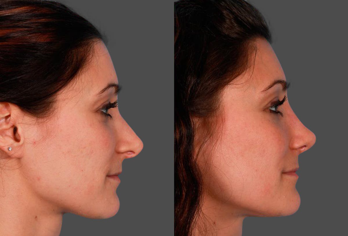 Revision Rhinoplasty Before & After Gallery - Patient 338022 - Image 2