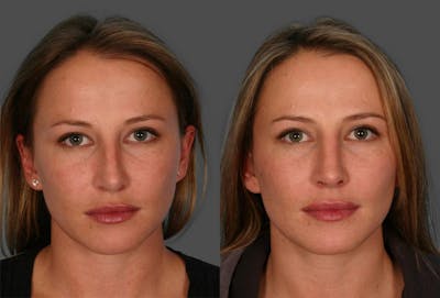Revision Rhinoplasty Before & After Gallery - Patient 339282 - Image 1