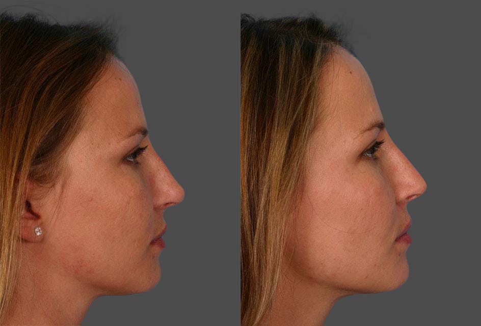 Revision Rhinoplasty Before & After Gallery - Patient 339282 - Image 2