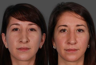 Revision Rhinoplasty Before & After Gallery - Patient 466512 - Image 1