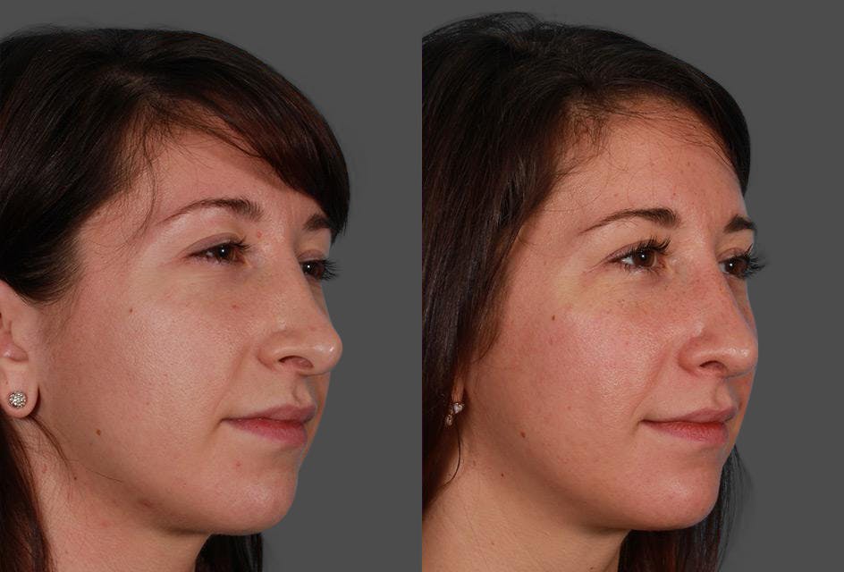 Revision Rhinoplasty Before & After Gallery - Patient 466512 - Image 2