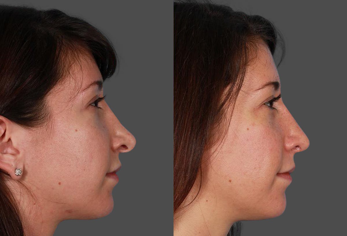 Revision Rhinoplasty Before & After Gallery - Patient 466512 - Image 3