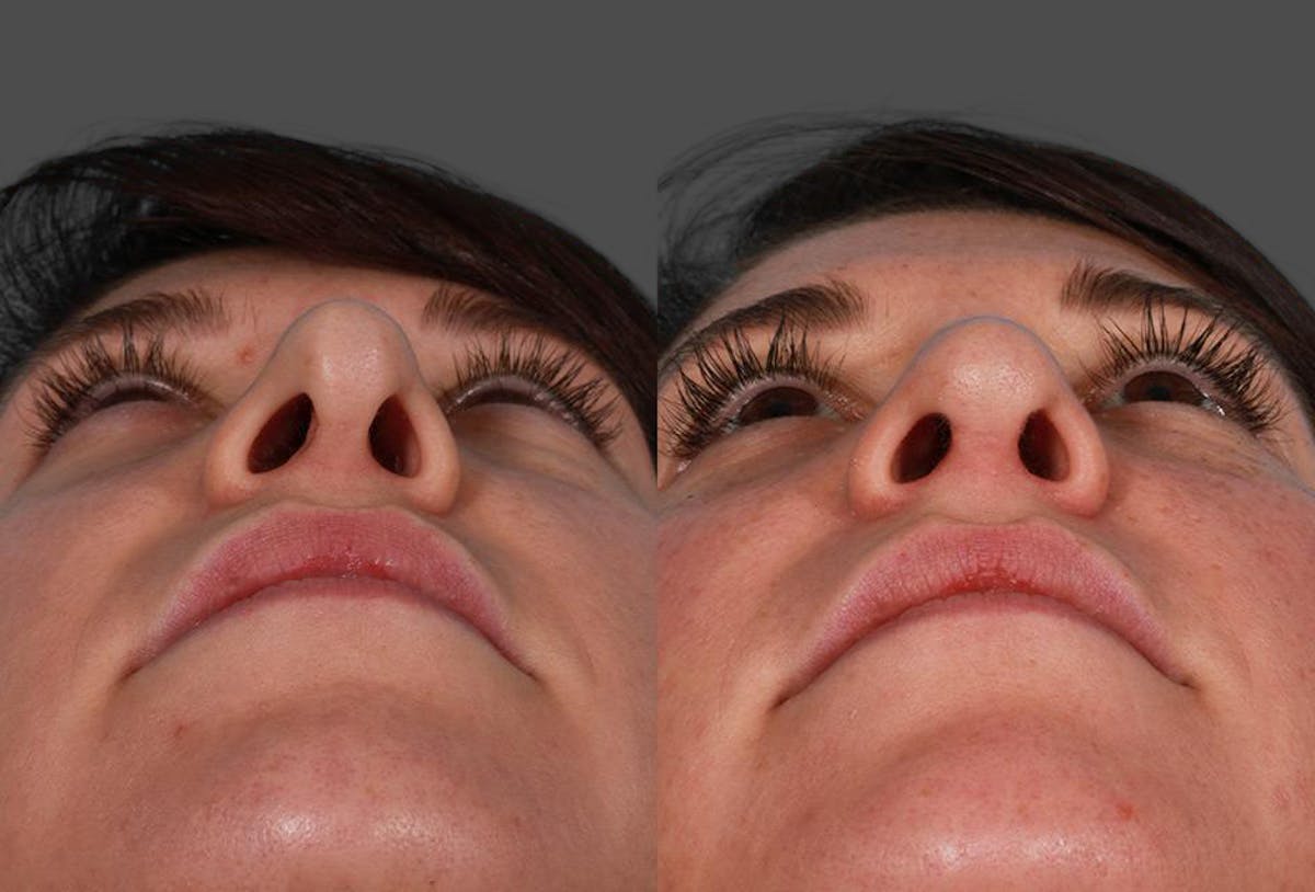Revision Rhinoplasty Before & After Gallery - Patient 466512 - Image 4