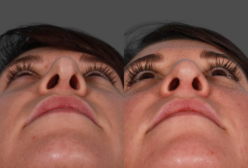 Revision Rhinoplasty Before & After Gallery - Patient 466512 - Image 4