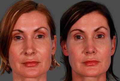 Revision Rhinoplasty Before & After Gallery - Patient 644281 - Image 1