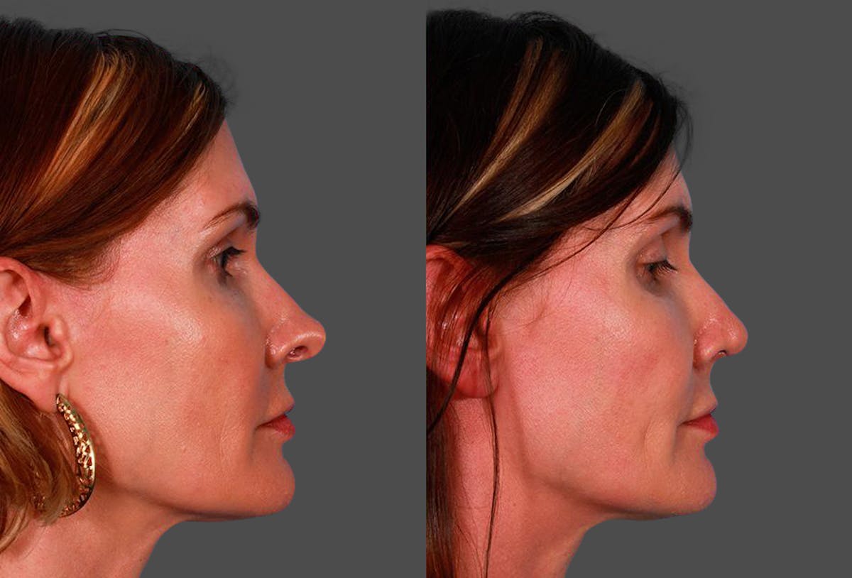 Revision Rhinoplasty Before & After Gallery - Patient 644281 - Image 2