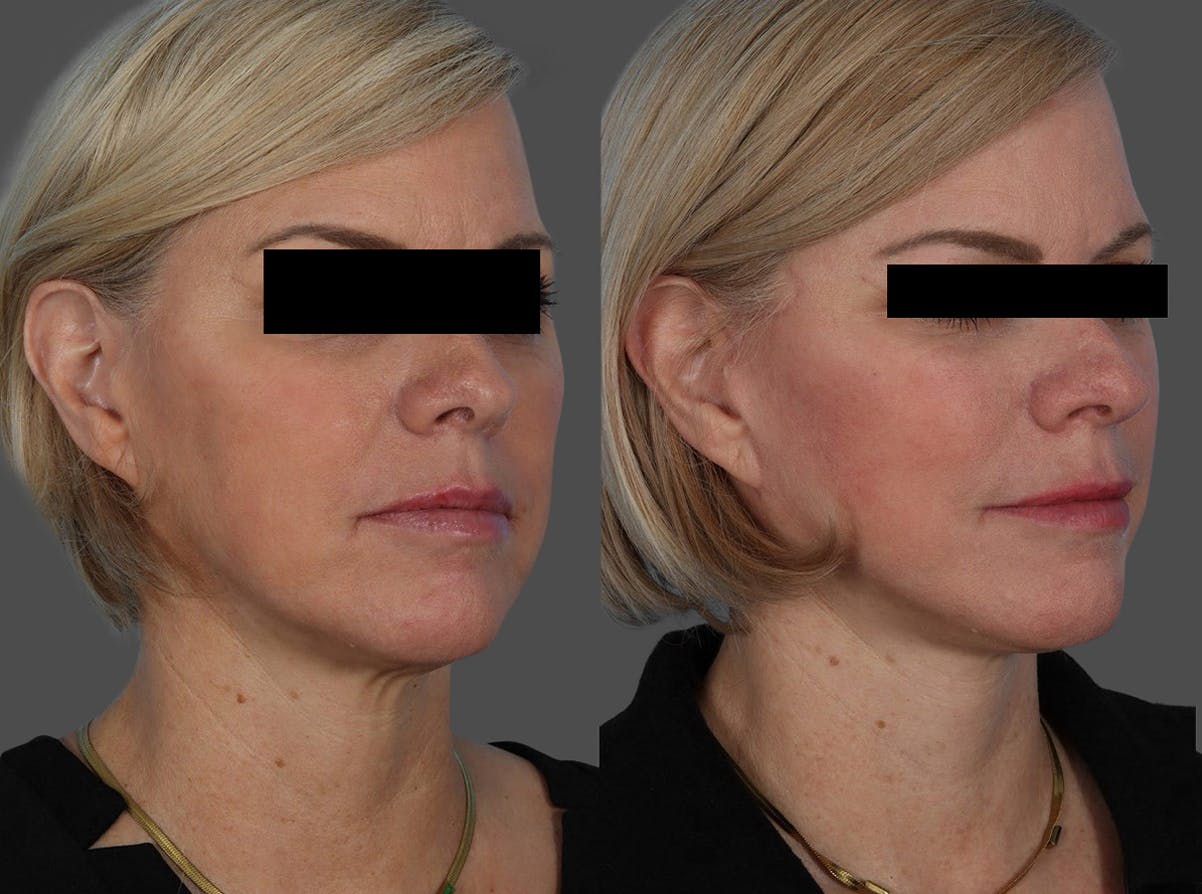 Skin Cancer Before & After Gallery - Patient 159606 - Image 2