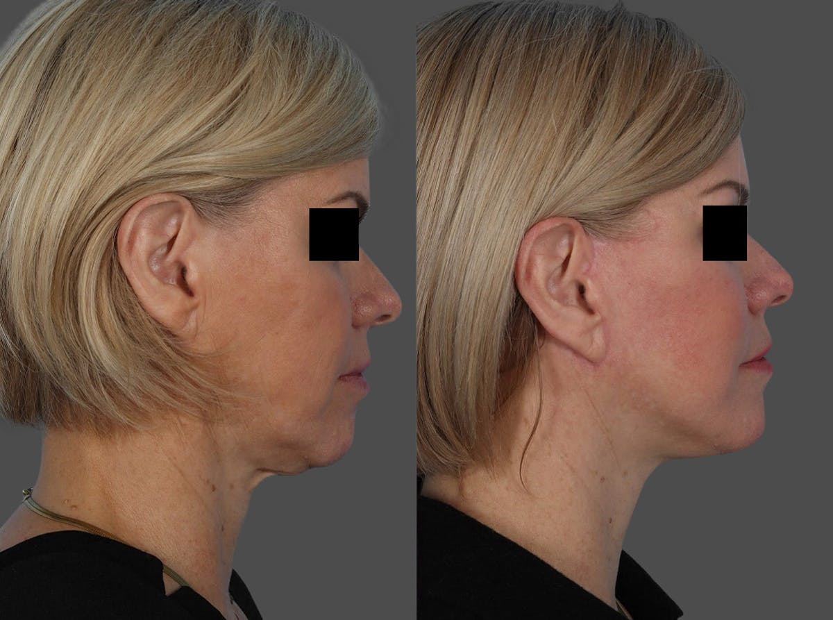 Skin Cancer Before & After Gallery - Patient 159606 - Image 3