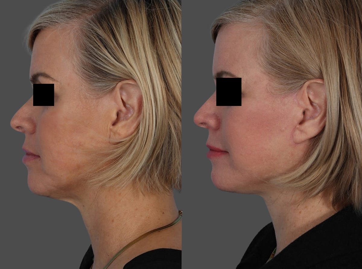 Skin Cancer Before & After Gallery - Patient 159606 - Image 5