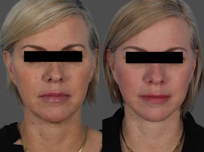 Skin Cancer Before & After Gallery - Patient 159606 - Image 1
