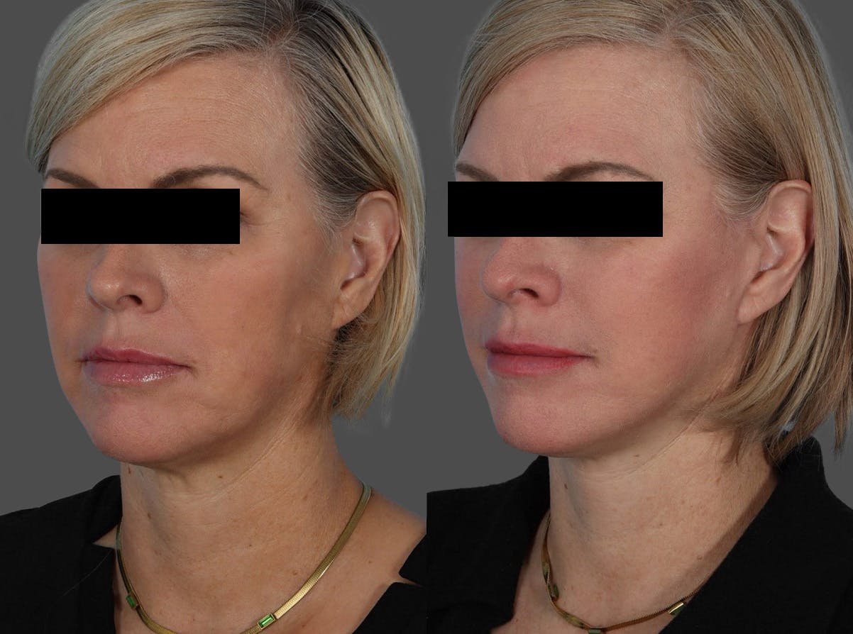 Skin Cancer Before & After Gallery - Patient 159606 - Image 4