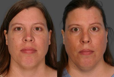 Skin Cancer Before & After Gallery - Patient 425246 - Image 1