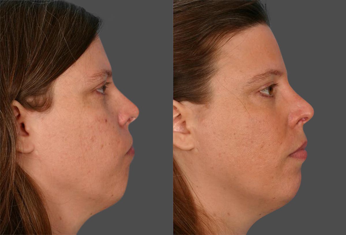 Skin Cancer Before & After Gallery - Patient 425246 - Image 2