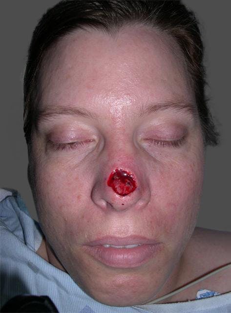 Skin Cancer Before & After Gallery - Patient 425246 - Image 3