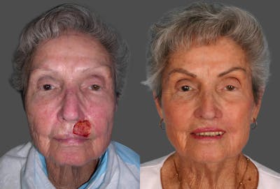 Skin Cancer Before & After Gallery - Patient 266455 - Image 1